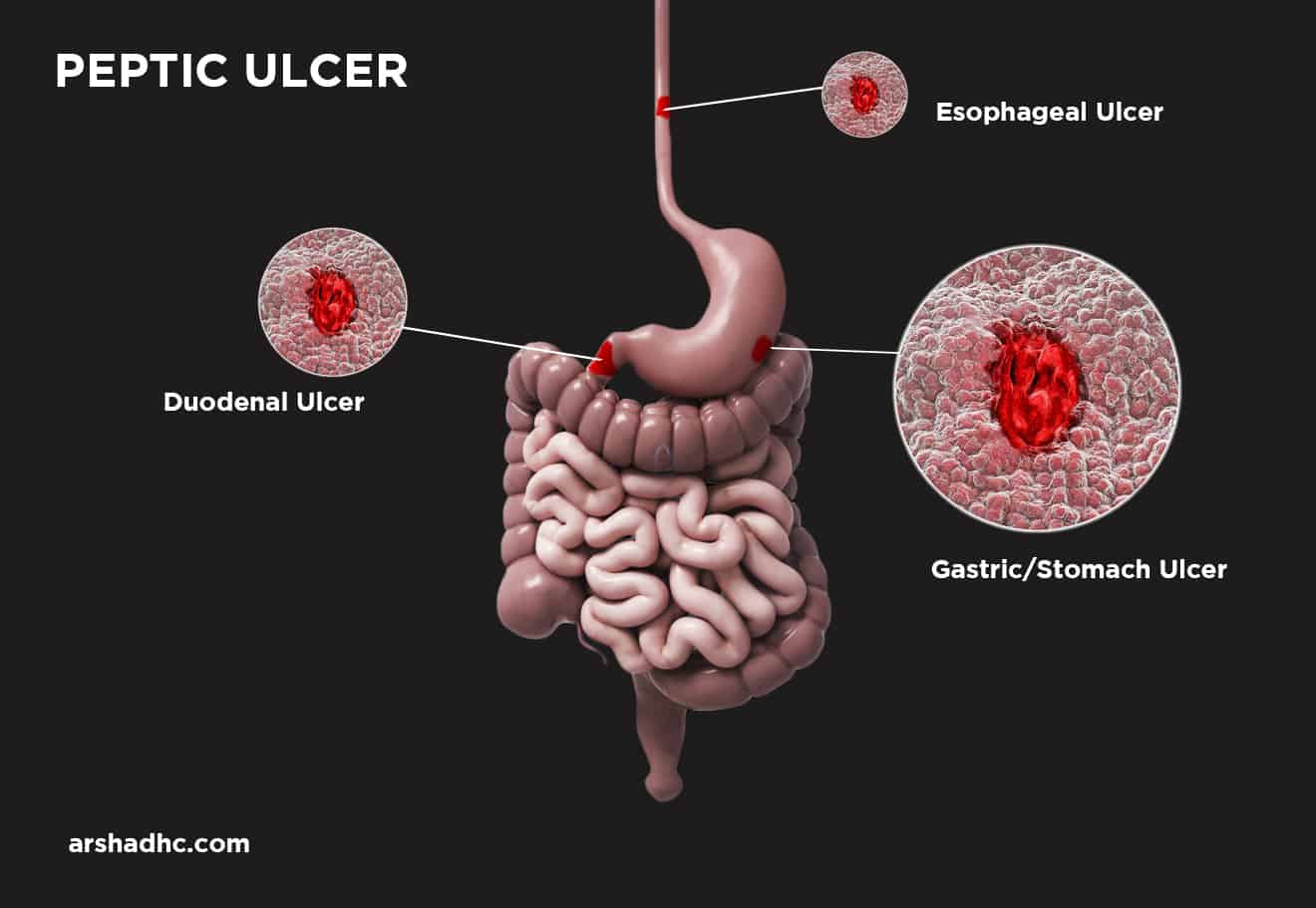 Peptic ulcer